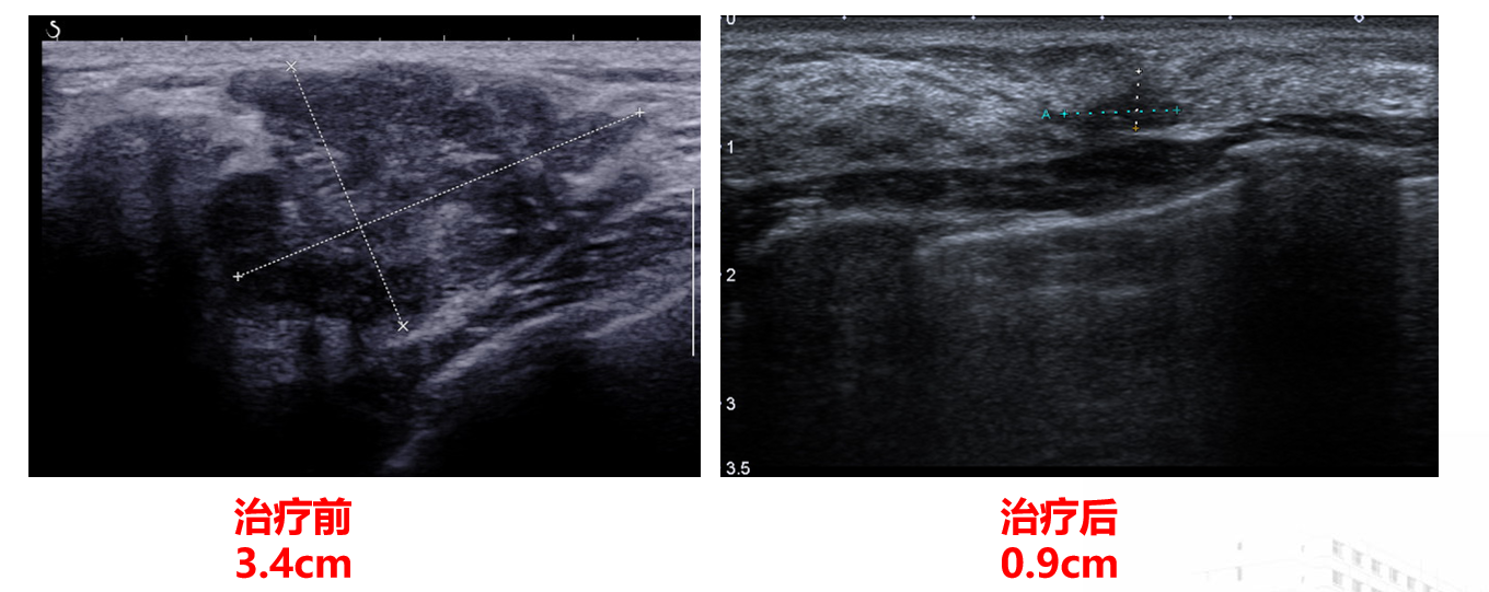 乳腺癌先化疗有什么好处?哪些适合先化疗?