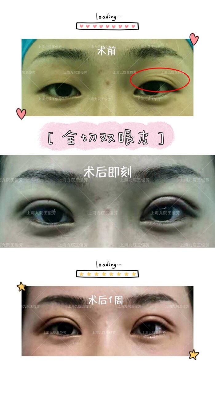 全切双眼皮案例分享眼皮多层皱褶的解决方法