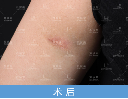 经过手术后,多年盘踞在李欣手臂上的疤痕疙瘩被成功祛除.