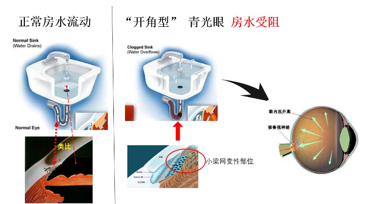 什么是开角型,什么是 闭角型?_青光眼 - 好大夫在线