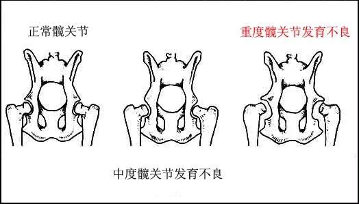 髋关节发育不良对婴儿来说到底意味着什么?