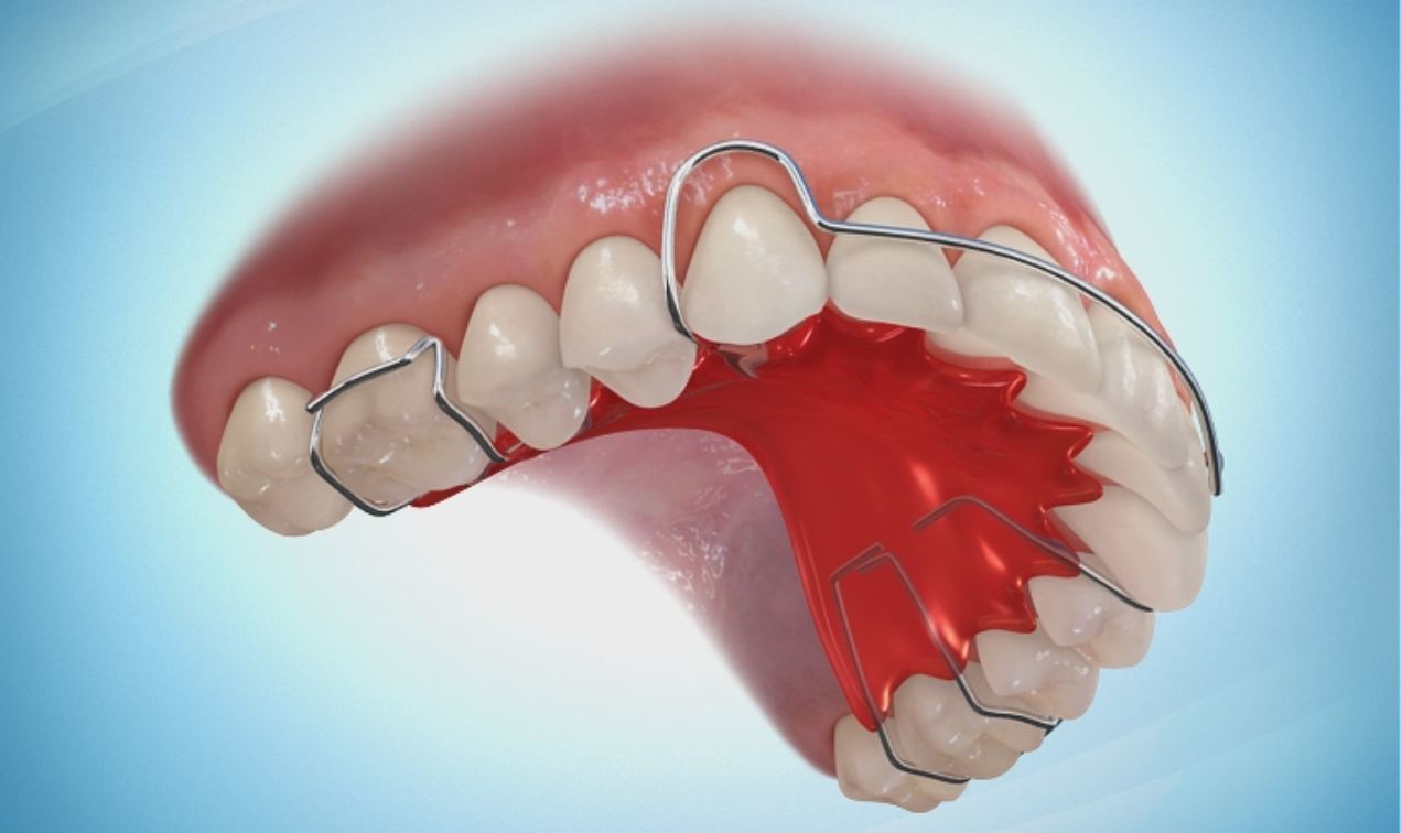 这种保持器,可以使牙齿小量移动,或通过调节唇弓关闭前牙少量间隙,也