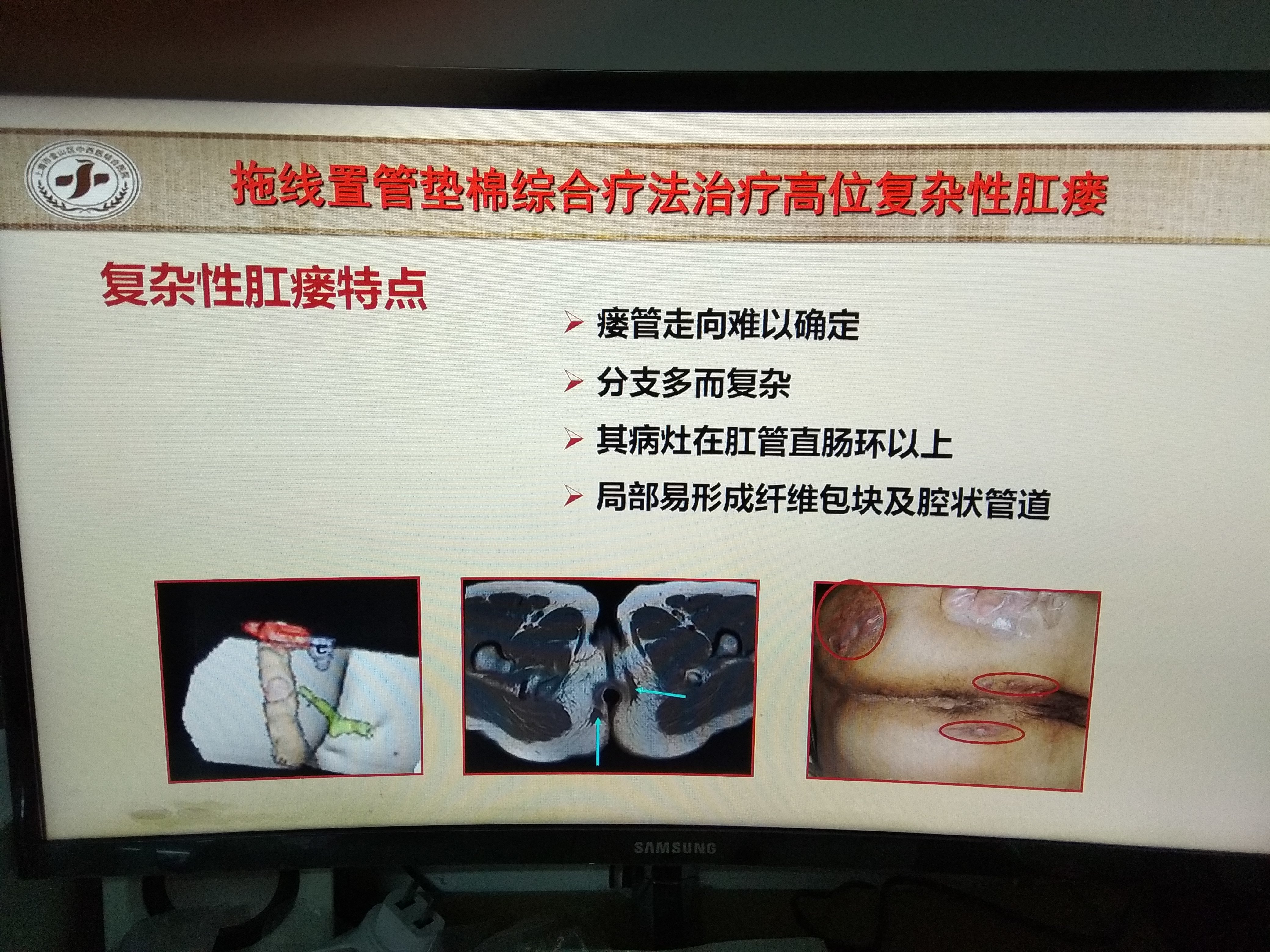 拖线置管垫棉综合疗法治疗高位复杂性肛瘘