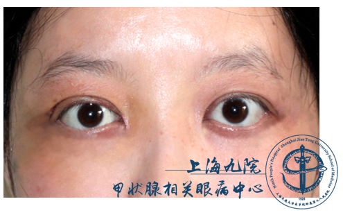 甲状腺相关眼病患者,眼球重度突出眼眶减压术后,眼球回退到正常位置