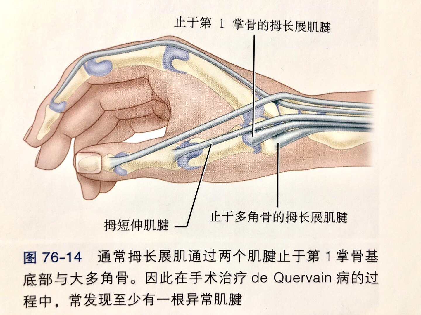 桡骨茎突狭窄性腱鞘炎dequervain病介绍