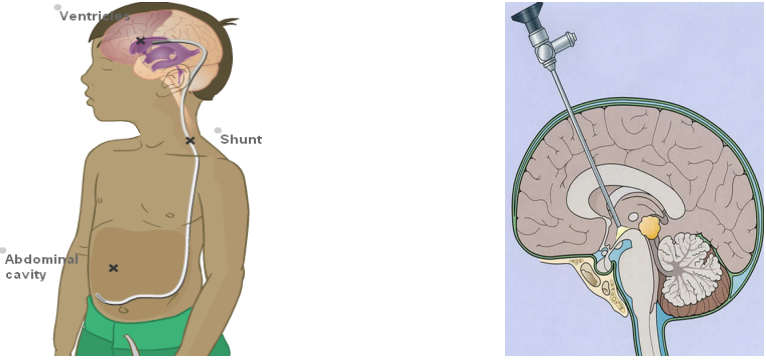 传统脑室腹腔分流术脑室镜下脑积水分流术
