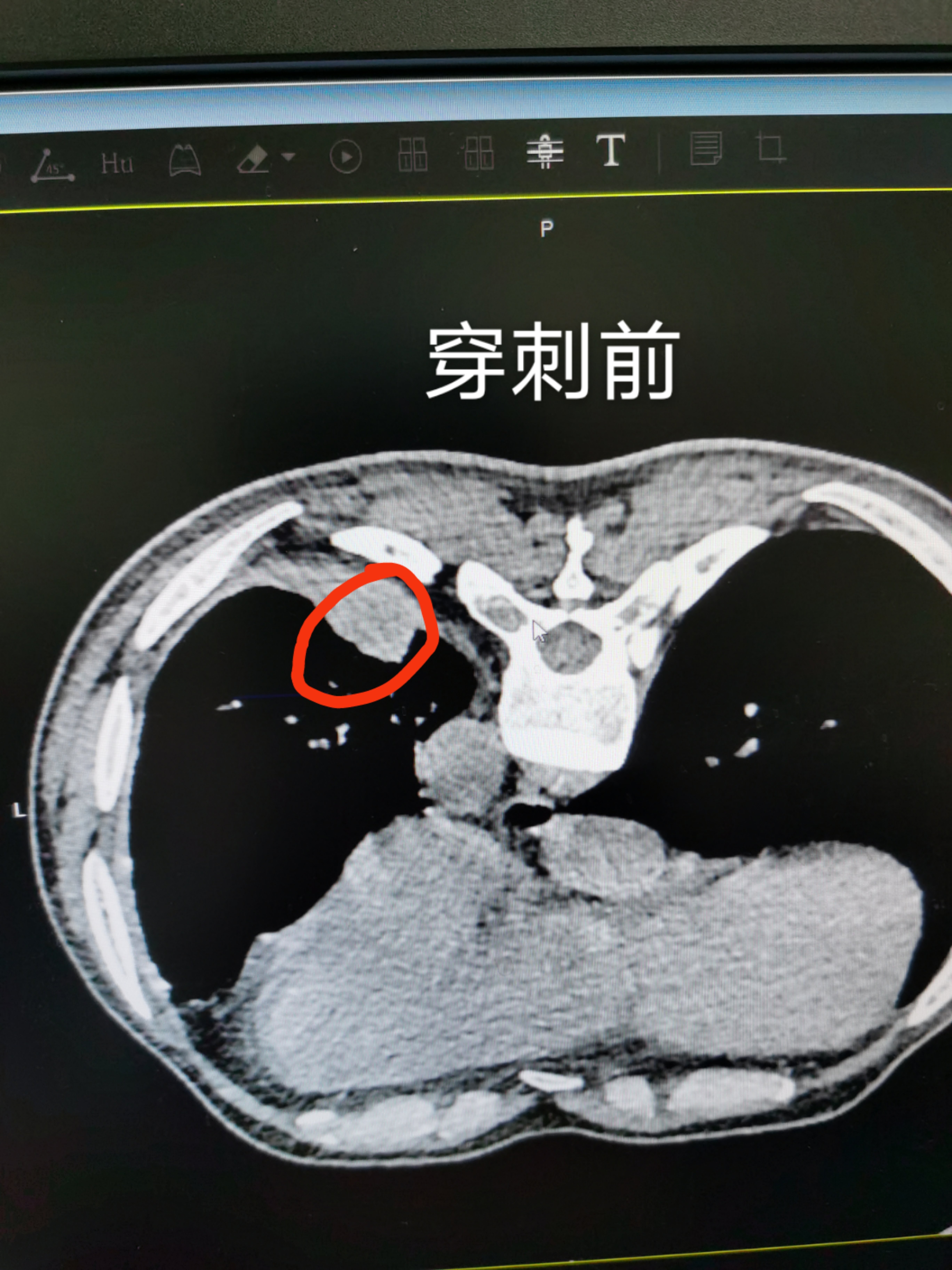 肺结节需要做肺穿刺吗