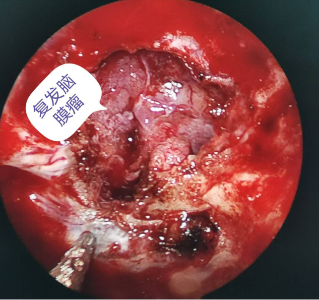 脑膜瘤术后15年复发,不开颅一次性彻底切除肿瘤!