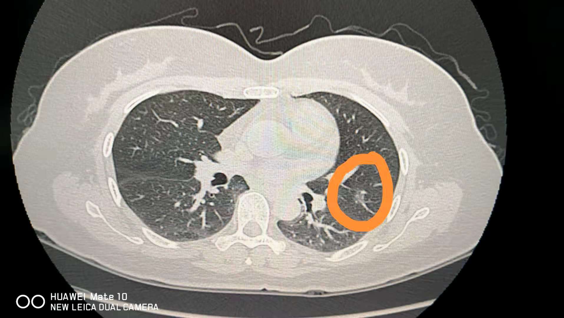 体检发现肺磨玻璃结节不必惊慌建议胸外科医师随访或微创手术一般术后