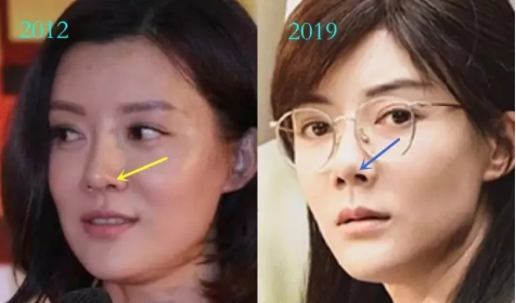 从2012到2019,我们可以看到鼻子的挛缩变化