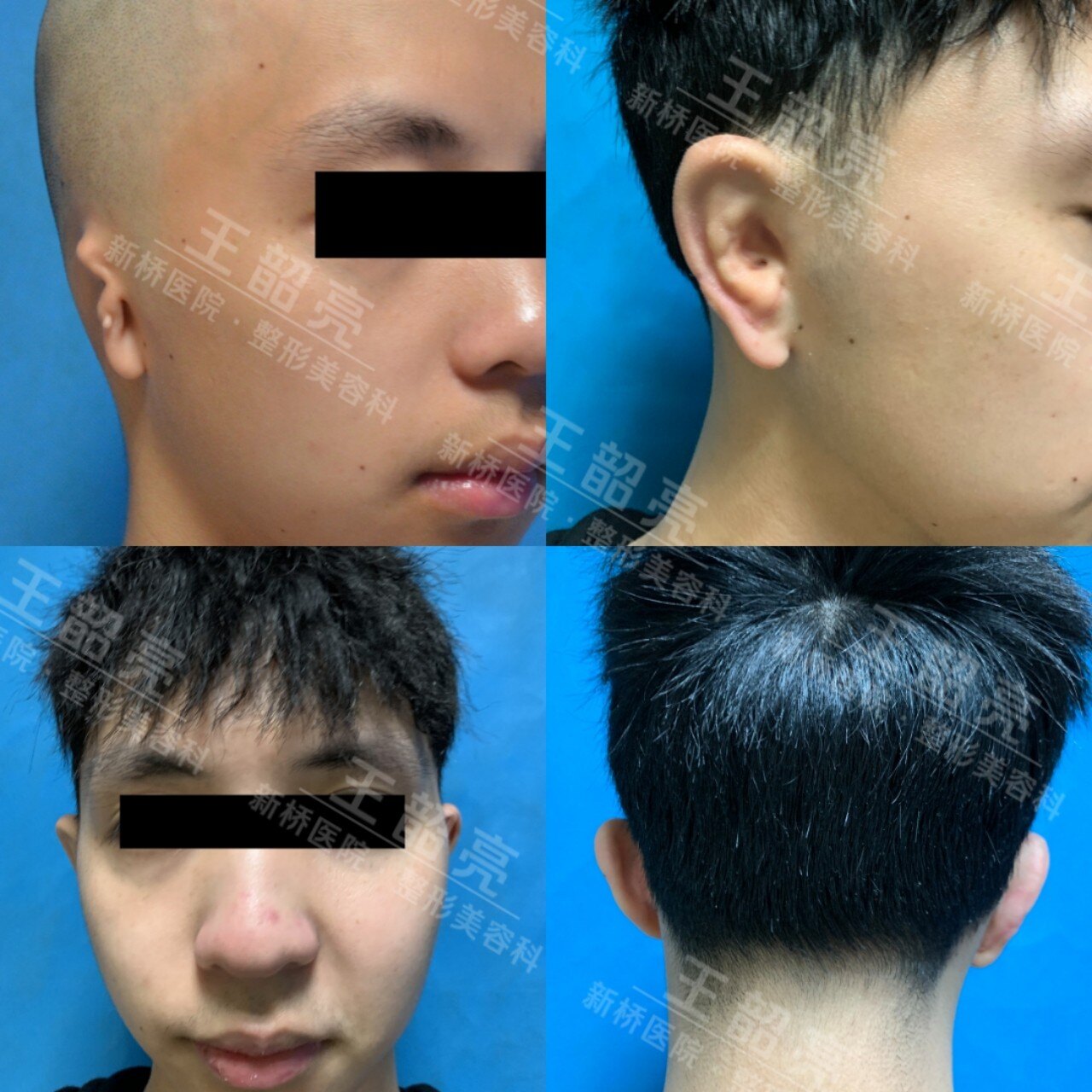 本人部分患者的术前术后照片如下:因小耳畸形再造耳为肋软骨支架异位