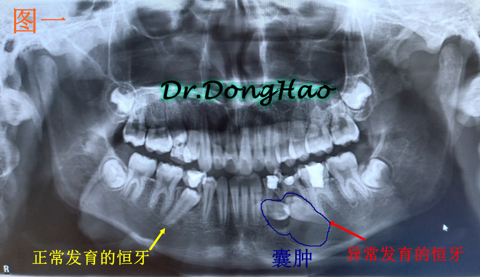 10岁了,这边的牙齿疼就在当地诊所看牙,一拍片就发现左边骨头里有东西
