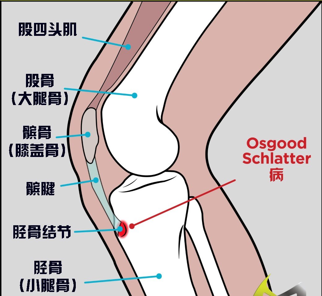 os病是小腿骨(胫骨)近端生长板(骨骺)的水肿和炎症.