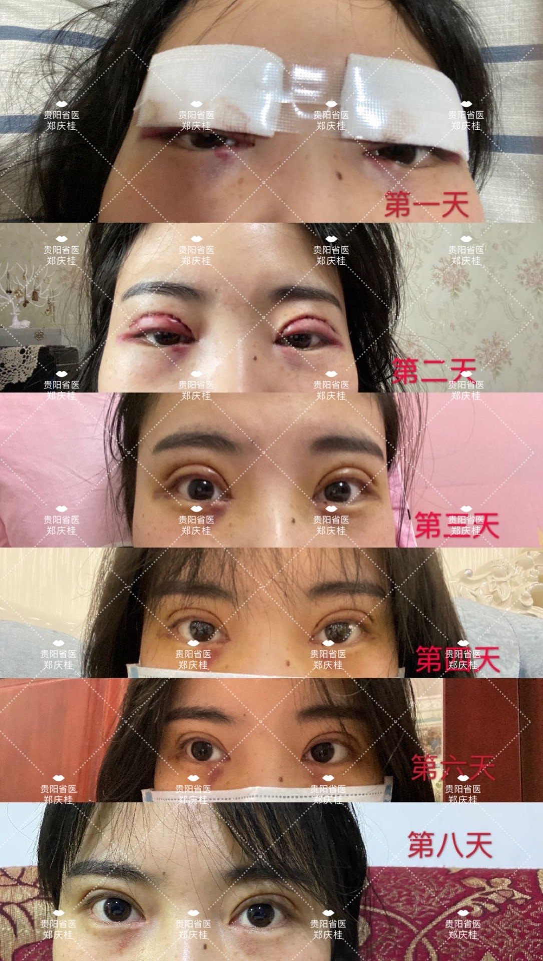 贵州贵阳双眼皮开眼角手术后2个月对比照片