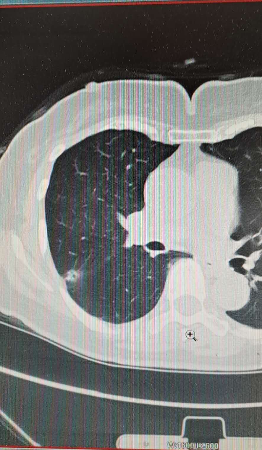 (空泡征,胸膜凹陷