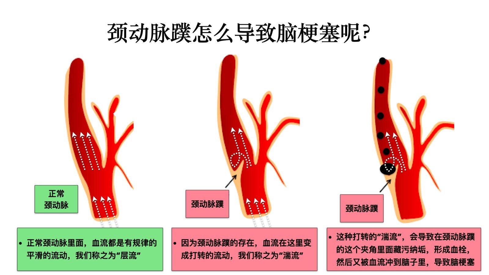 颈动脉蹼教您自己看懂这个病