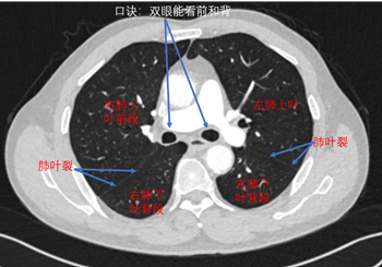 看见左右主支气管(双眼)层面:右肺上叶前段和右肺下叶背段,左肺上叶和