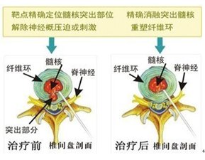 固缩,随时间的延长髓核对神经根的压迫消失;而对纤维环和其他组织结构