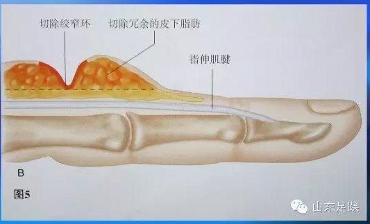 先天性束带综合征