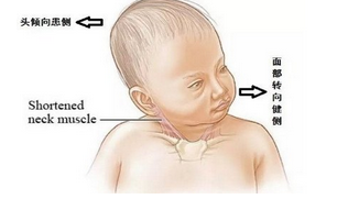小儿斜颈的诊治—让脖子改"斜"归正_斜颈_症状_检查_治疗方法_ 好