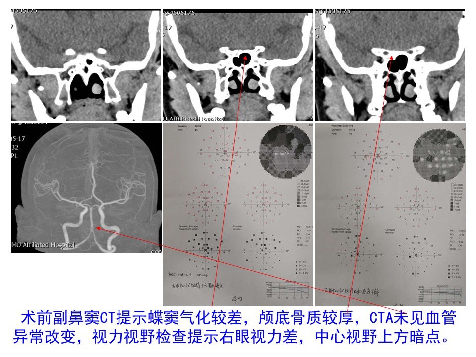 神经导航辅助内镜扩大经鼻入路切除蝶窦气化不良鞍结节脑膜瘤