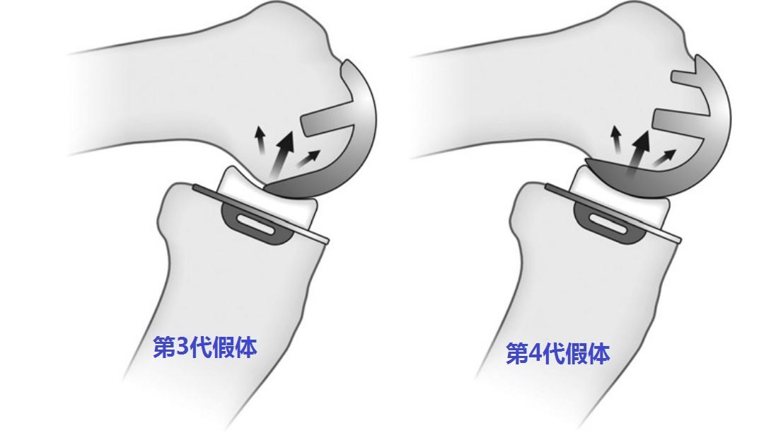 oxford牛津膝关节单髁置换手术选双柱假体or单柱假体