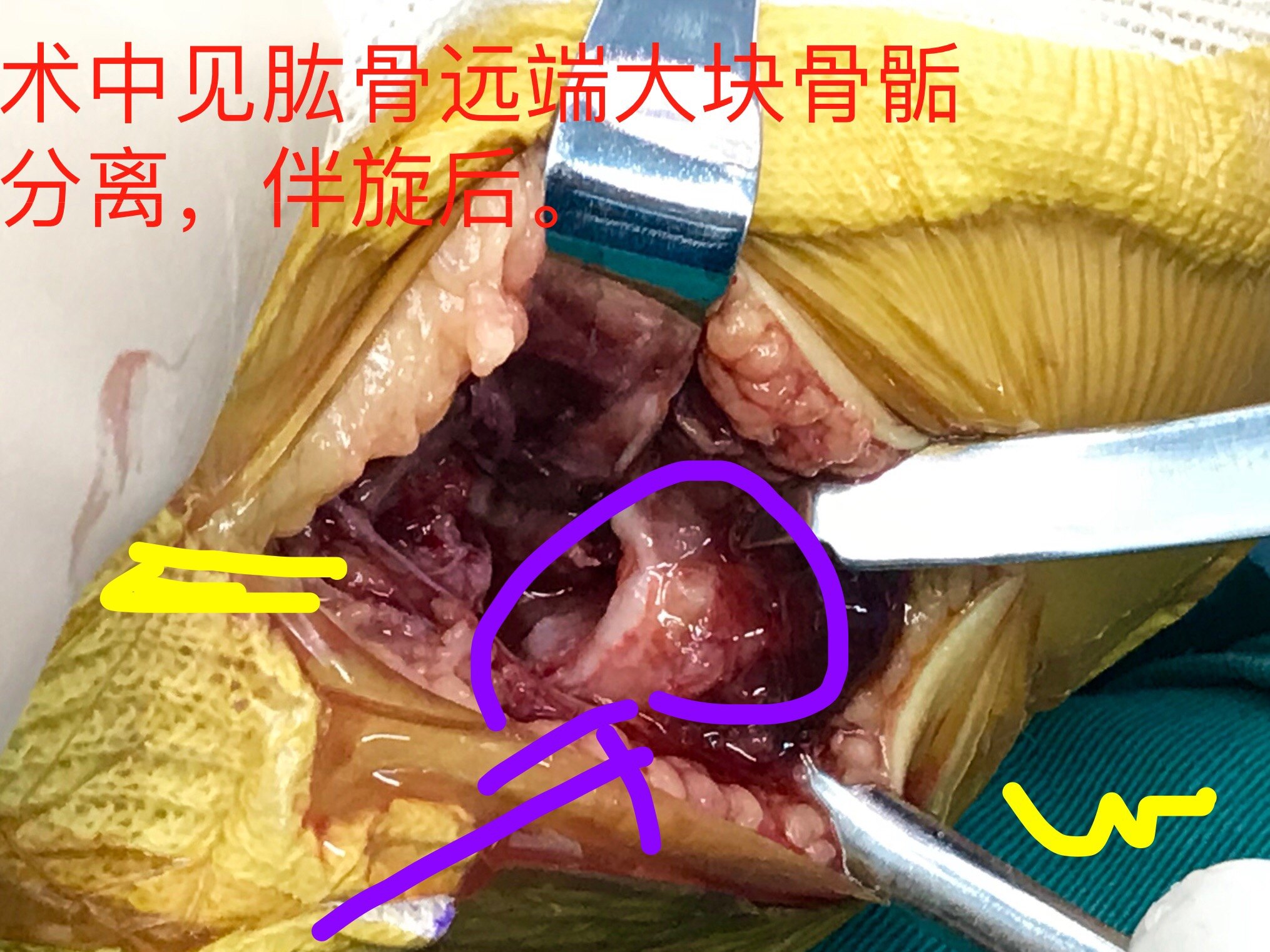 原创 易漏诊的婴幼儿肱骨远端全骨骺分离