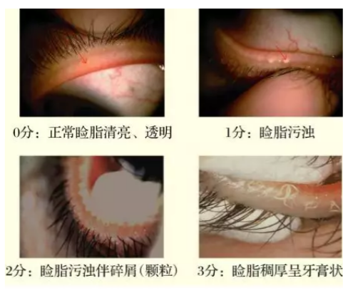 【郭海科 眼科继教】睑板腺功能障碍诊断与治疗