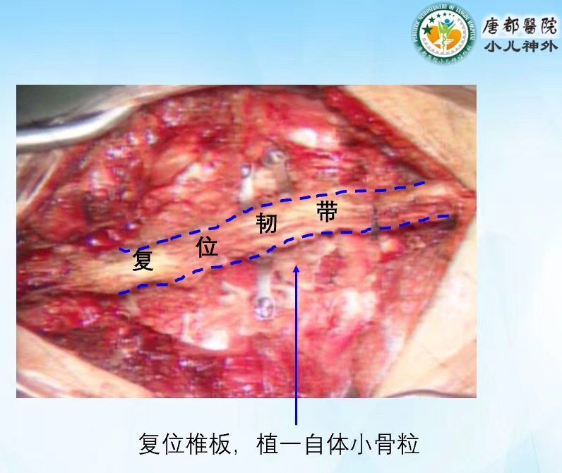 腰2椎管内表皮样囊肿