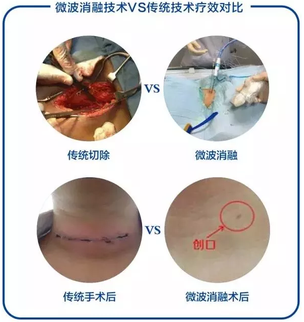 甲状腺微创治疗的新型手段—微波消融术