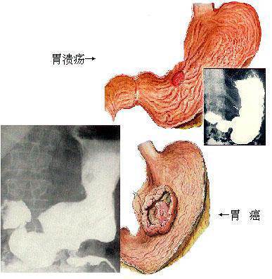 如何区分胃癌与胃溃疡