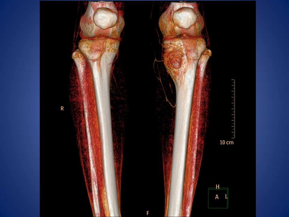 胫骨骨肉瘤肿瘤型膝关节假体置换术