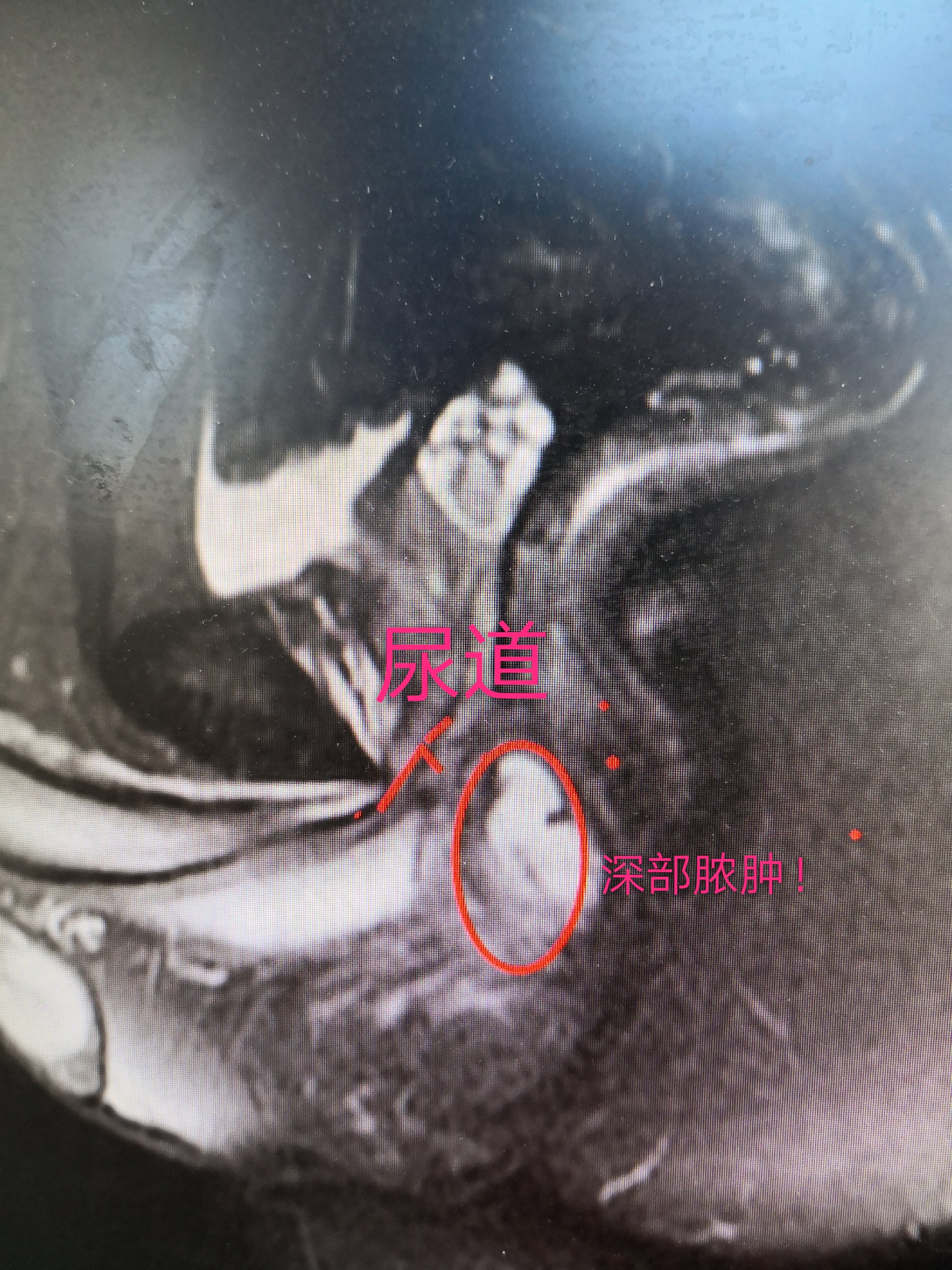 复杂肛周脓肿