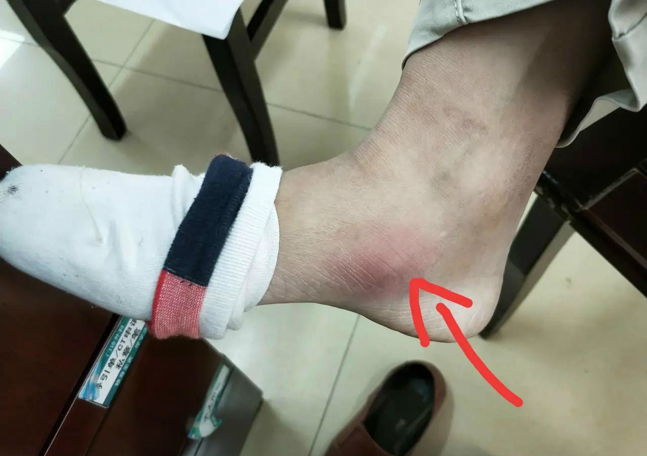 小伙脚上长了一个肿块,一查度娘差点把自己吓死