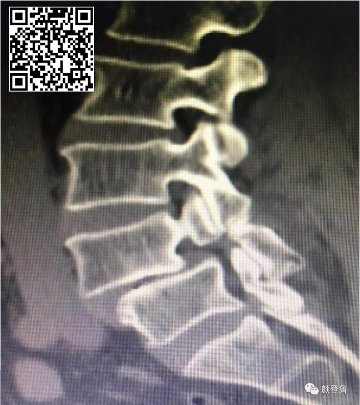 腰椎峡部裂的诊断和治疗