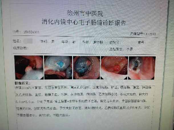 男性 43岁 结肠腺瘤性息肉 经emr治疗