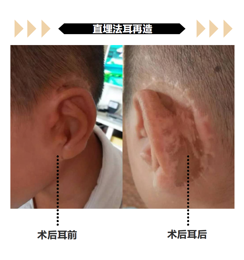 小耳症那些事儿(二十五)再造耳朵的颜色