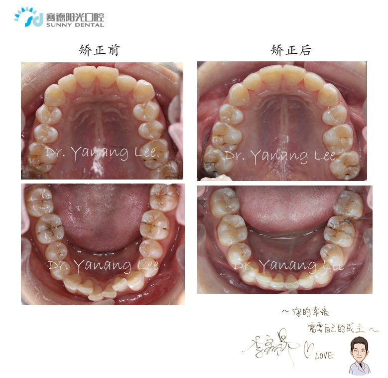 凸面型前牙深覆合覆盖矫正案例