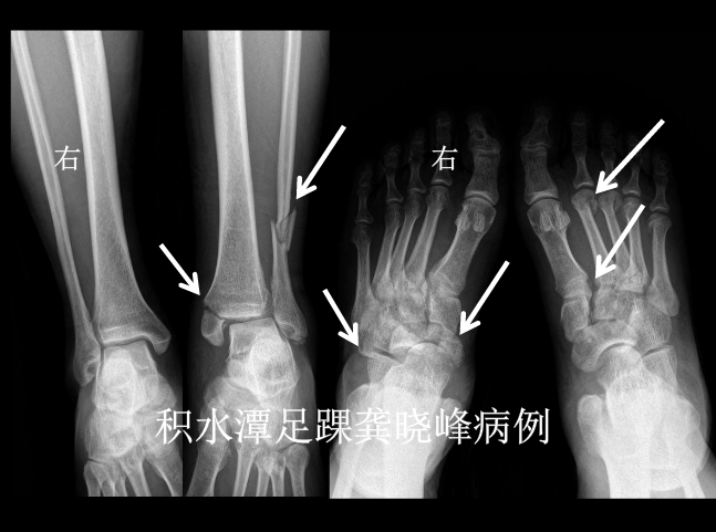 踝/chopart/lisfranc/舟骨/骰骨多处骨折