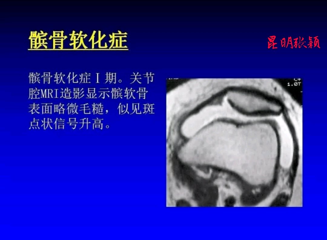 髌骨软化的原因 mip.haodf.com