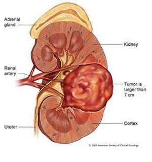 肾癌,无需恐惧的疾病(2015更新版)