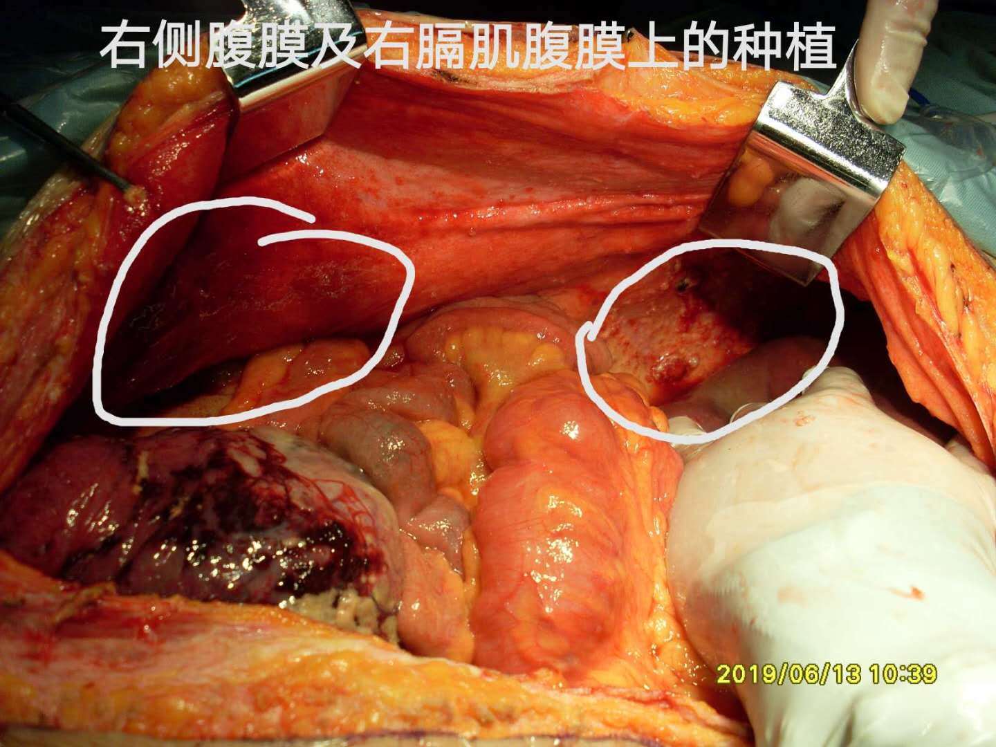 病例78-- 卵巢原发粘液腺癌保留一侧卵巢17月复发伴腹膜转移