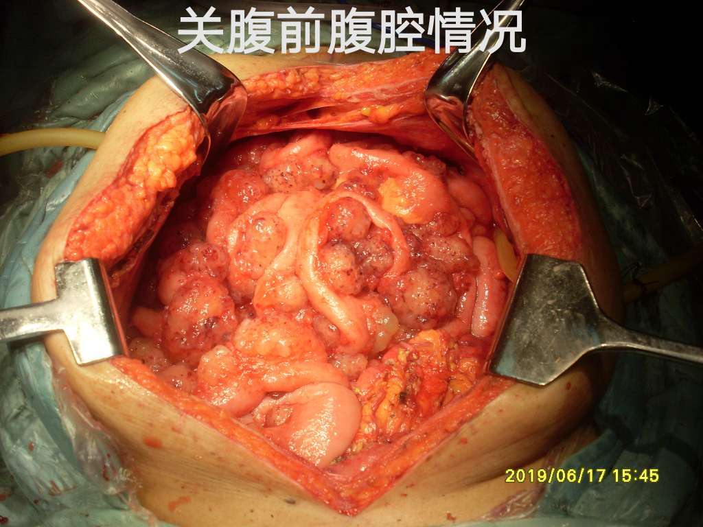 其它的腹膜及器官切除