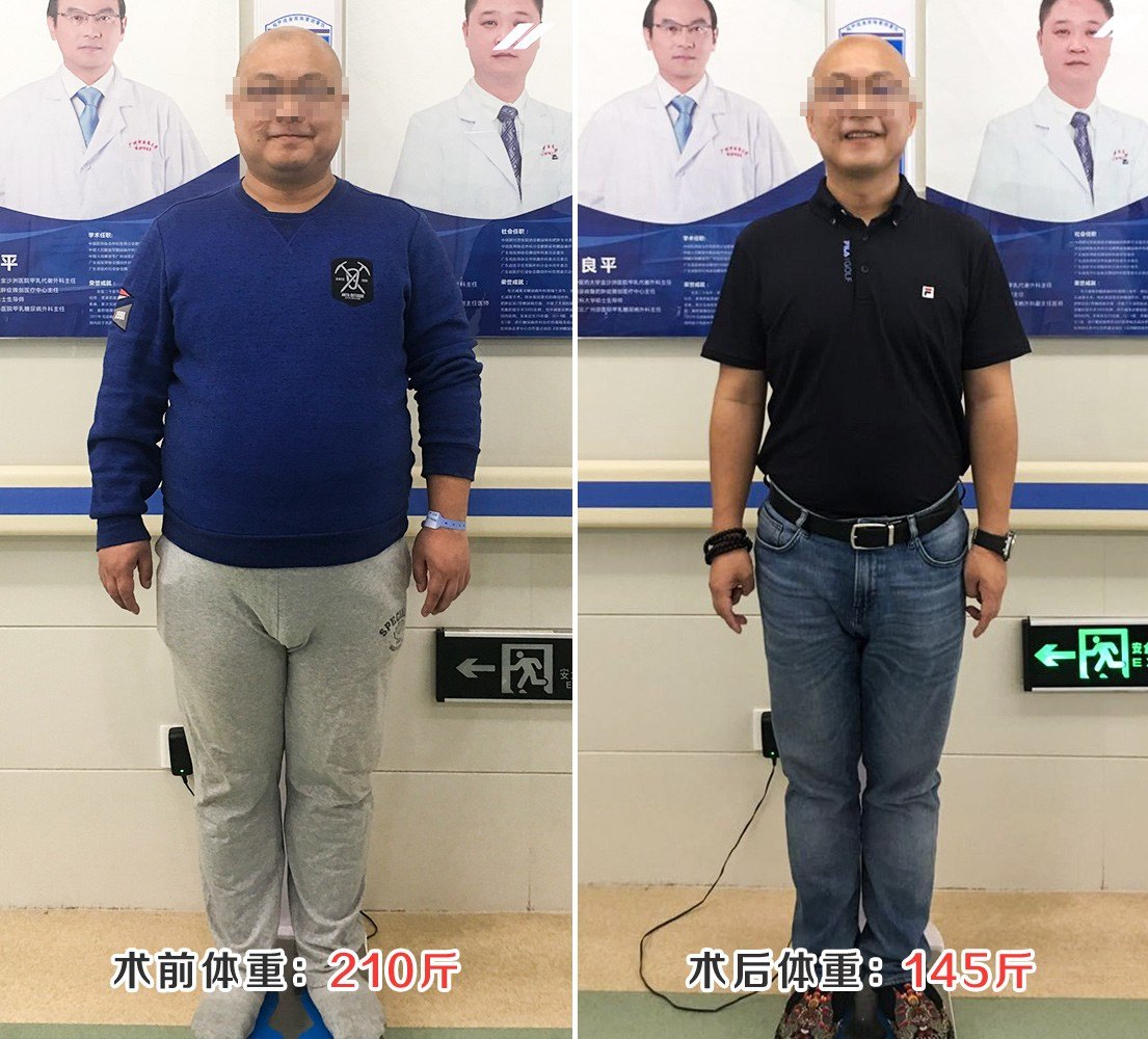 减重手术效果出乎他的意料,209斤心理咨询师半年瘦回学生时代