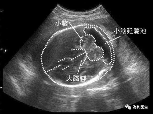 孕期超声解析什么是小脑延髓池增宽