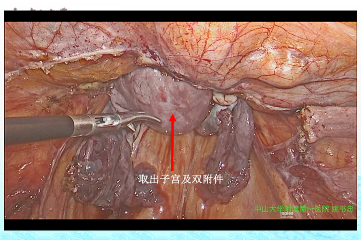 缝合结扎左侧子宫血管 21.  缝合阴道壁