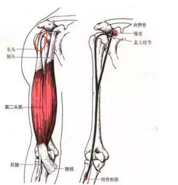 突发性肩痛一例——筋出槽?作者,刘华卫