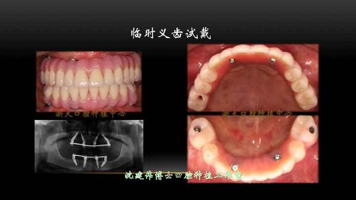 无牙颌的全口种植修复一例