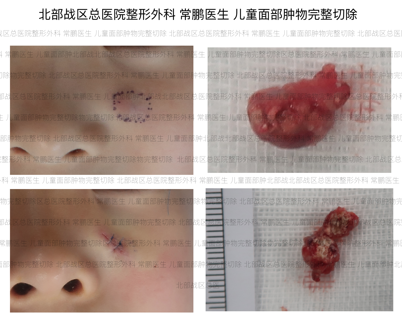 儿童面部的肿物是什么?