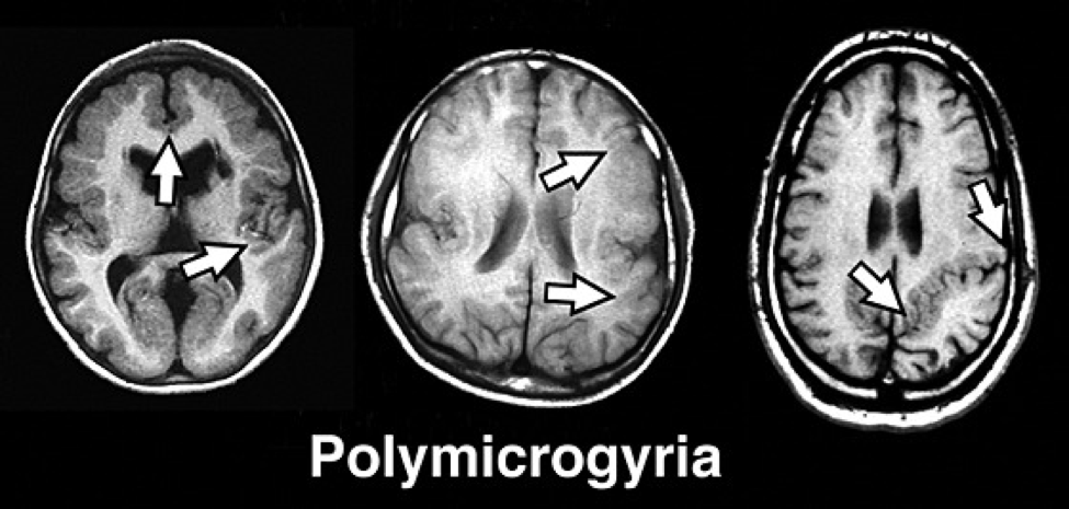 多小脑回畸形.png